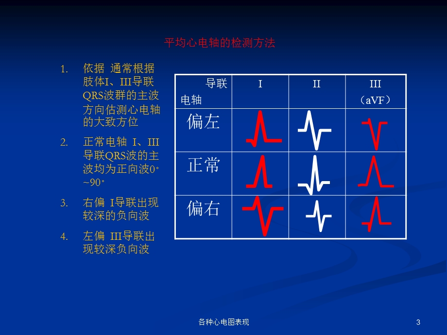 各种心电图表现培训课件.ppt_第3页