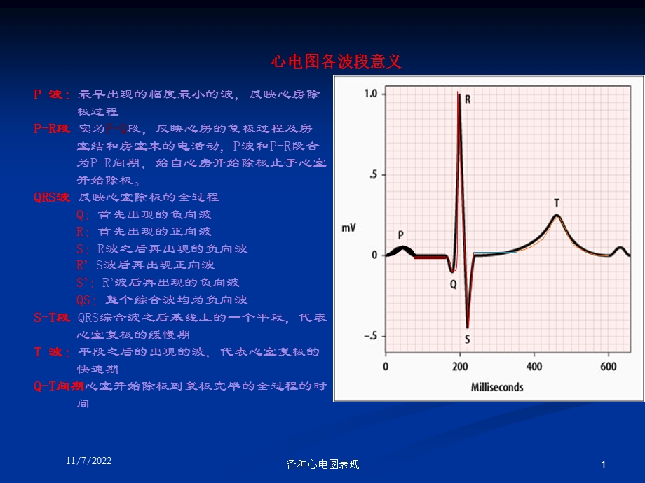 各种心电图表现课件.ppt_第1页