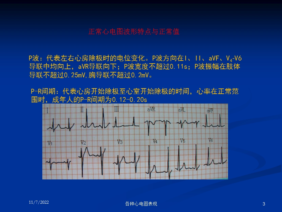 各种心电图表现课件.ppt_第3页