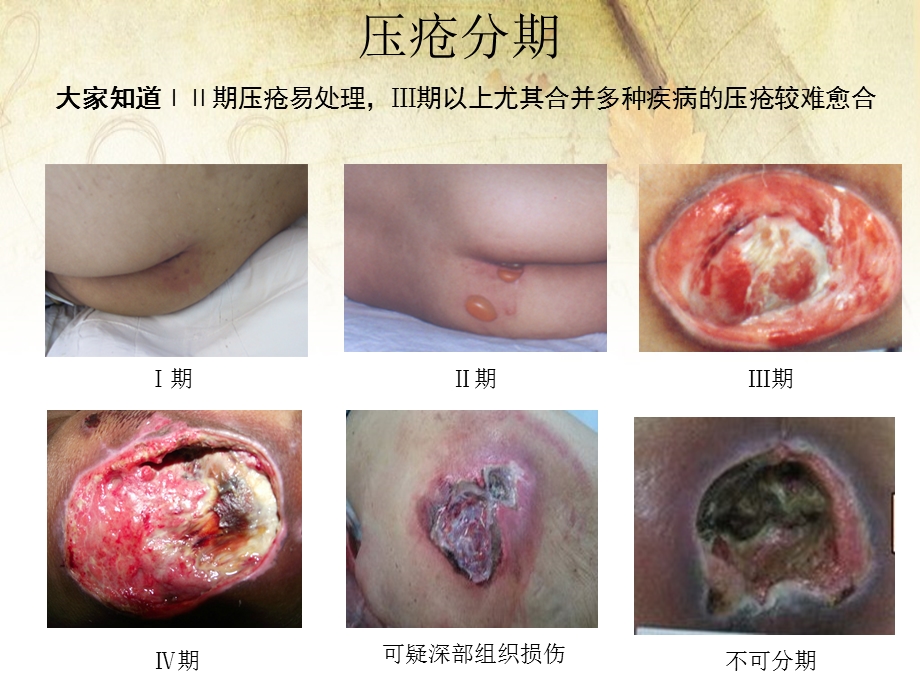 压疮个案护理查房ppt课件.ppt_第2页