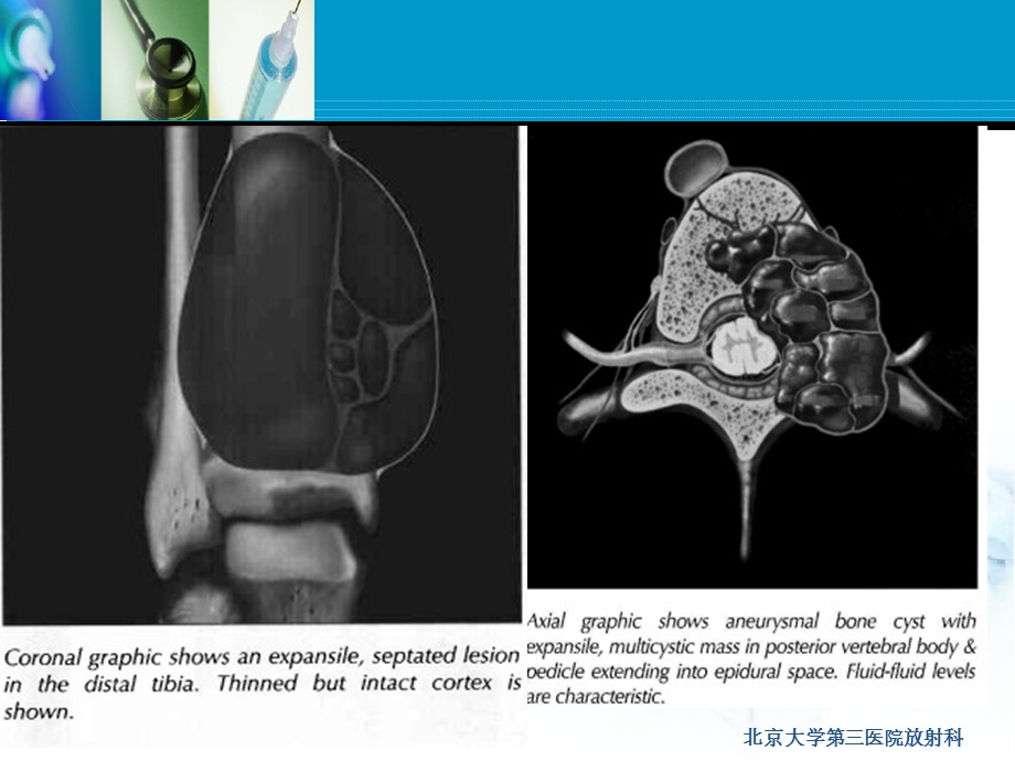 动脉瘤样骨囊肿ppt课件.ppt_第3页