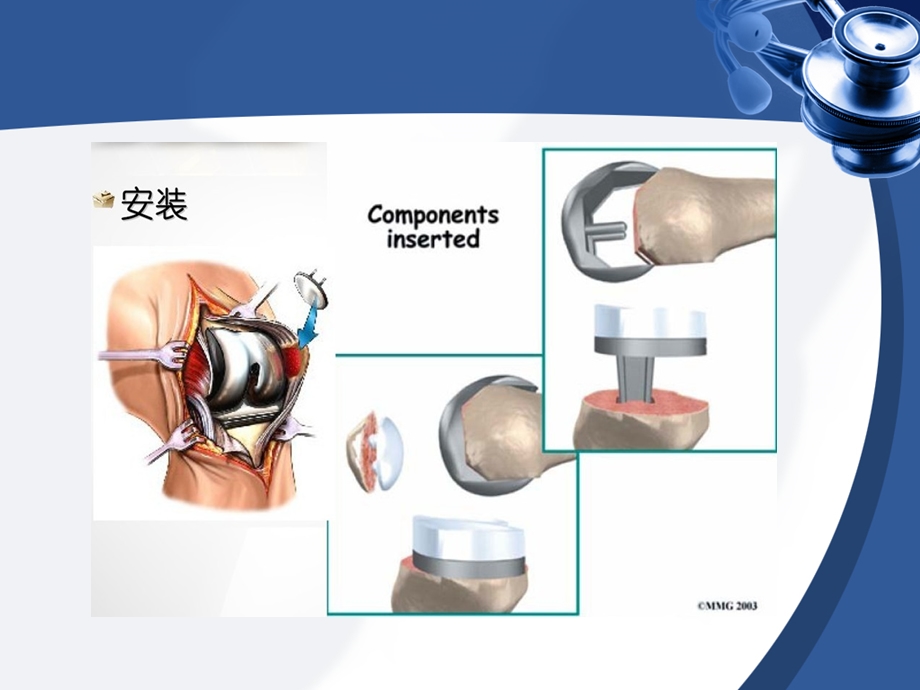 全膝关节置换ppt课件.pptx_第2页