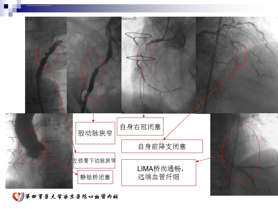 冠心病患者血糖异常的管理ppt课件.ppt_第2页