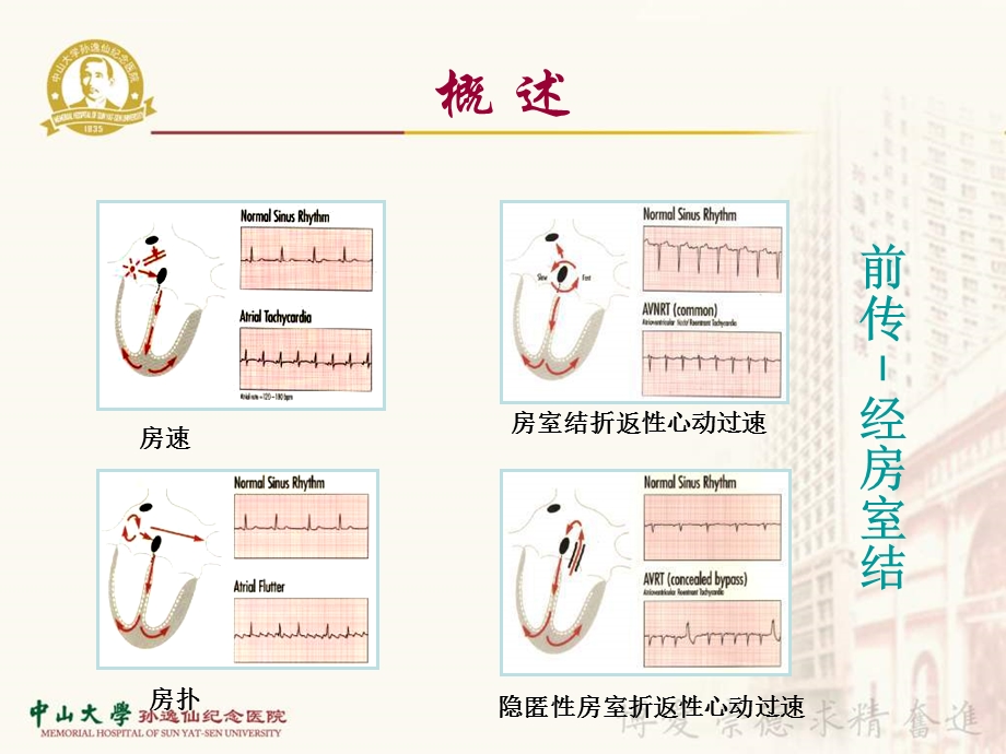 周淑娴窄QRS波心动过速鉴别诊断ppt课件.ppt_第3页