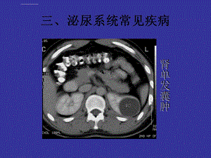 单发肾囊肿ppt课件.ppt