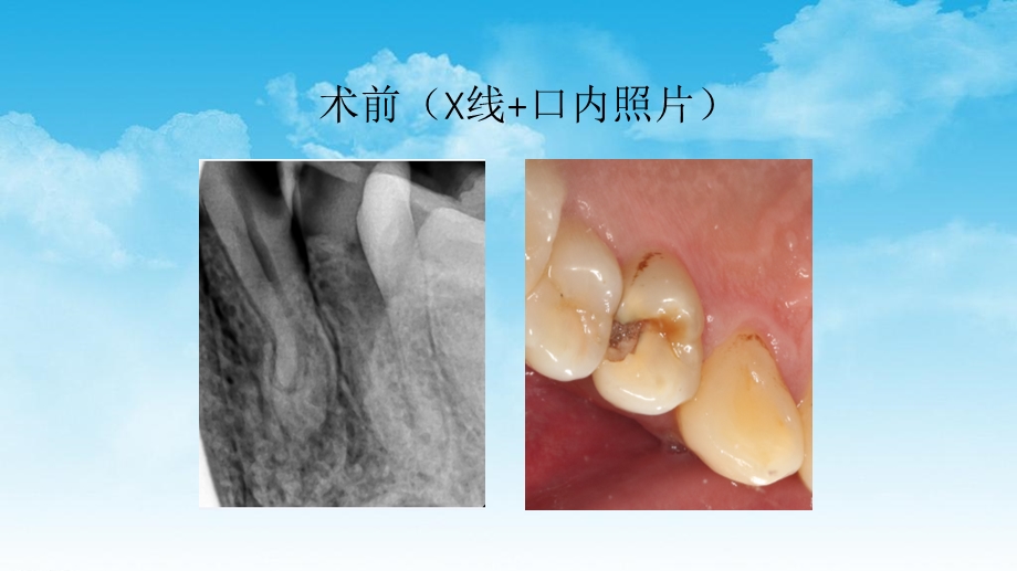 前磨牙根管治疗后高嵌体修复病例ppt课件.pptx_第2页