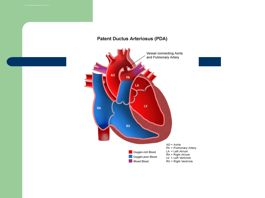 动脉导管未闭ppt课件.ppt_第3页