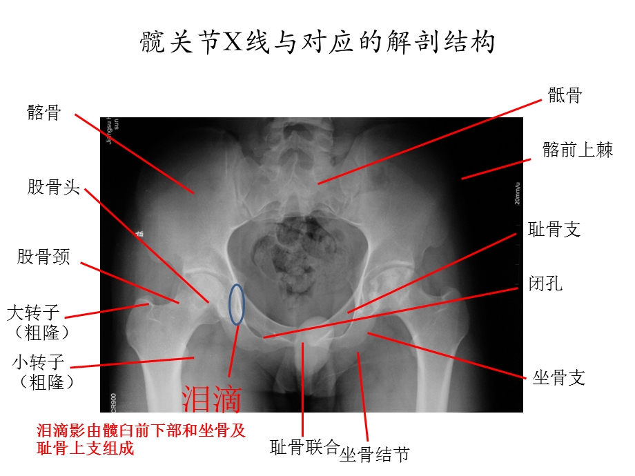 全髋关节置换术中的精确重建ppt课件.pptx_第2页