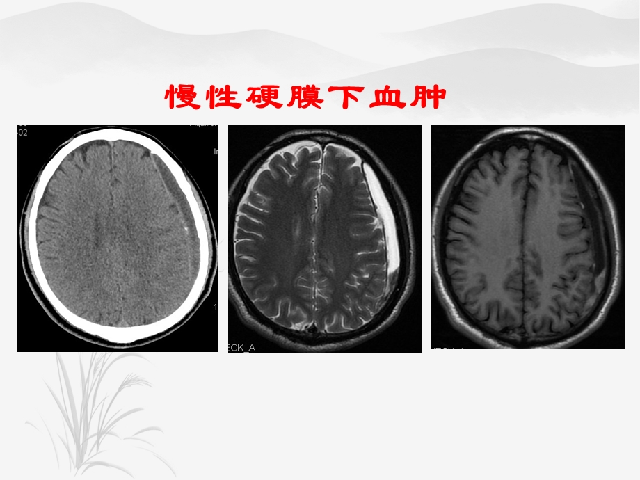 制作精美慢性硬膜下血肿诊治及护理ppt课件.ppt_第1页