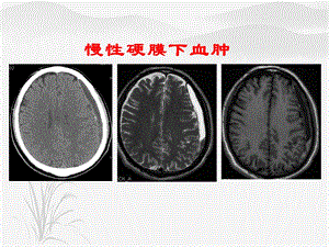 制作精美慢性硬膜下血肿诊治及护理ppt课件.ppt