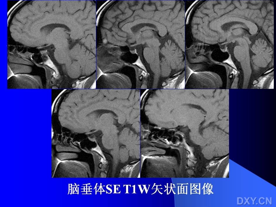 垂体瘤MR表现ppt课件.ppt_第3页