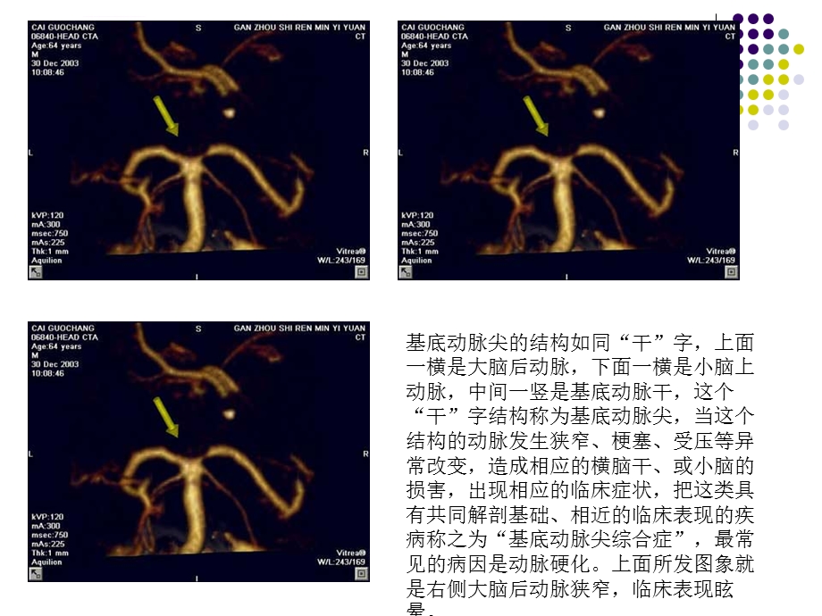 基底动脉尖ppt课件.ppt_第3页