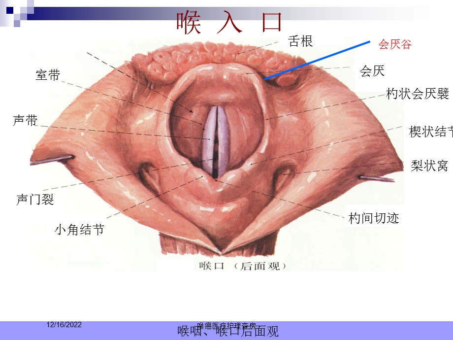 喉癌医疗护理查房课件.ppt_第3页