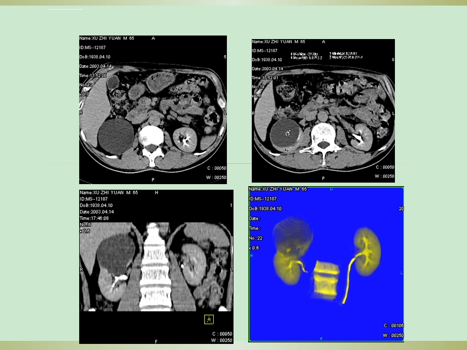 复杂性肾囊肿ppt课件.ppt_第3页