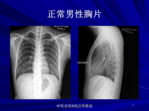 呼吸系统X线应用基础培训课件.ppt