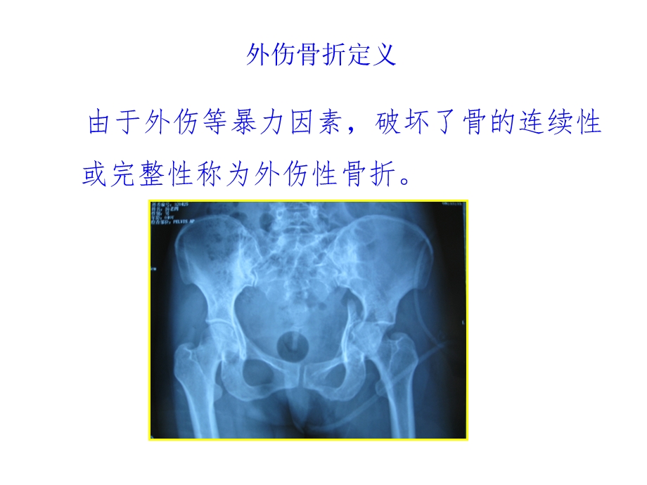 四肢骨折现场急救外固定技术标准版课件.ppt_第3页