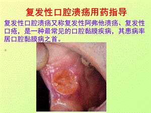 复发性口腔溃疡用药指导ppt课件.ppt