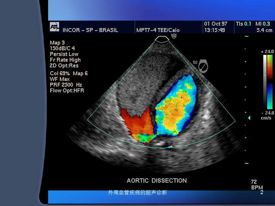 外周血管疾病的超声诊断课件.ppt_第2页