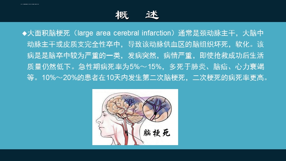 大面积脑梗塞ppt课件.ppt_第2页