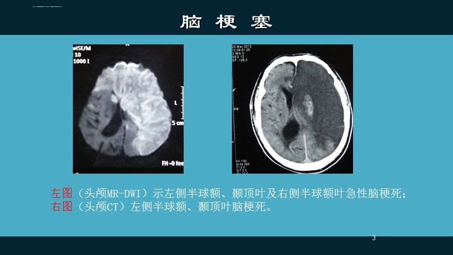 大面积脑梗塞ppt课件.ppt_第3页