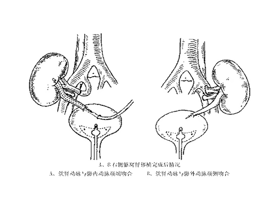 器官移植病人的麻醉课件.pptx_第3页