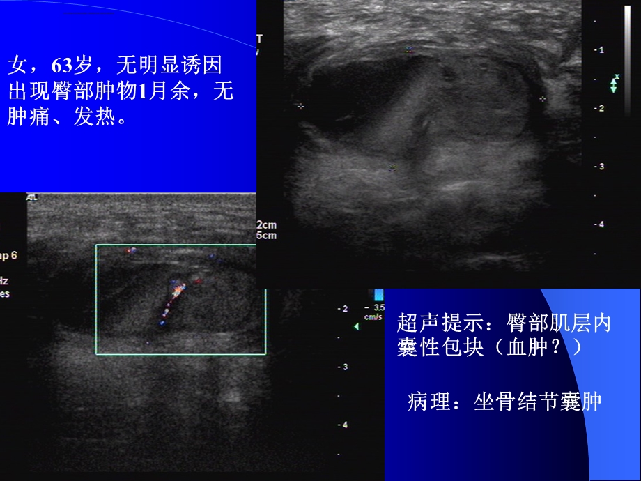 坐骨结节囊肿ppt课件.ppt_第1页