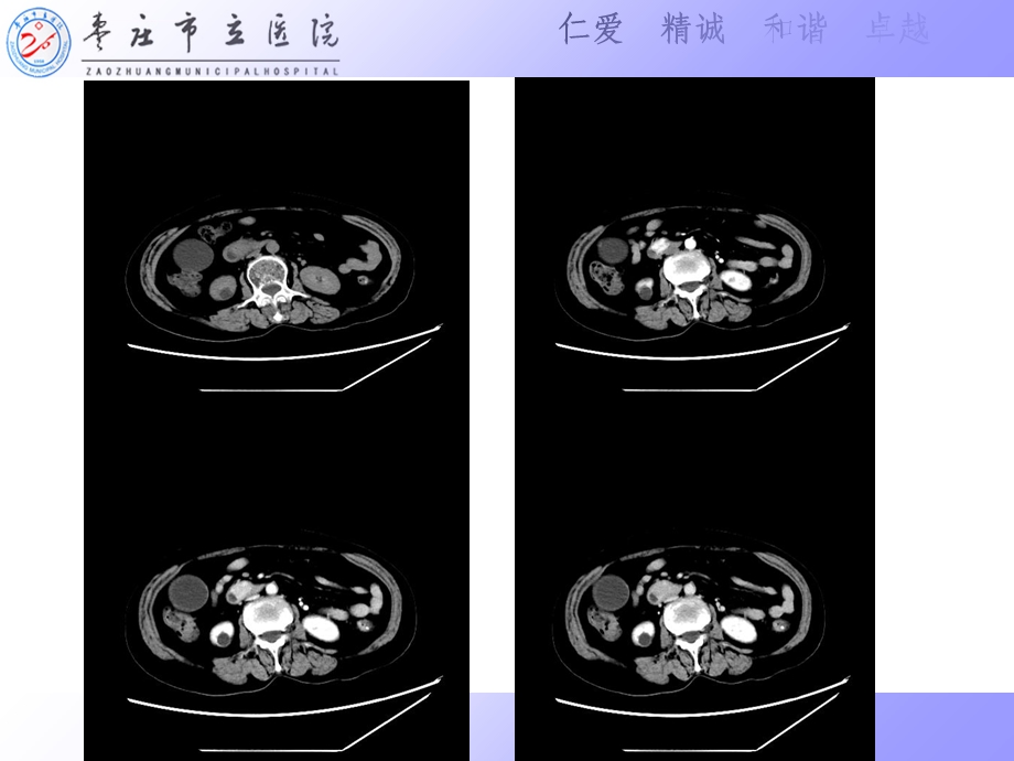 壶腹部占位的影像学表现及鉴别诊断ppt课件.ppt_第2页