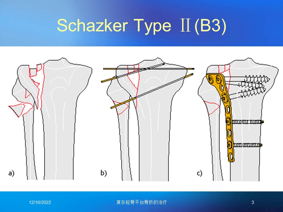 复杂胫骨平台骨折的治疗课件.ppt_第3页