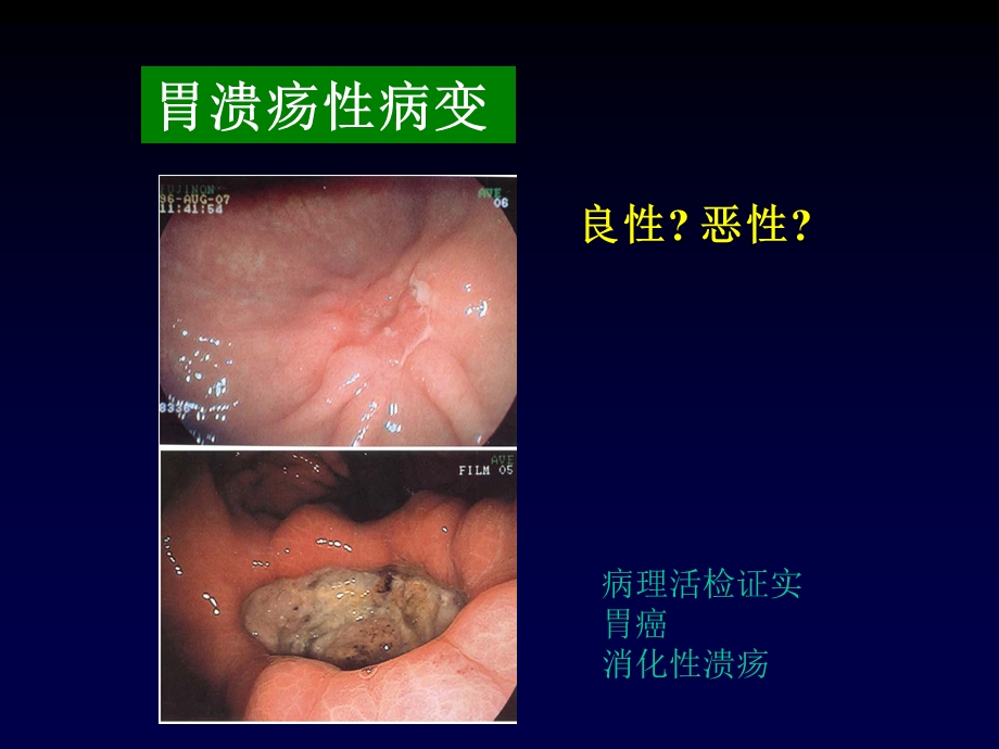 内镜诊断中的有关病理问题课件.ppt_第3页