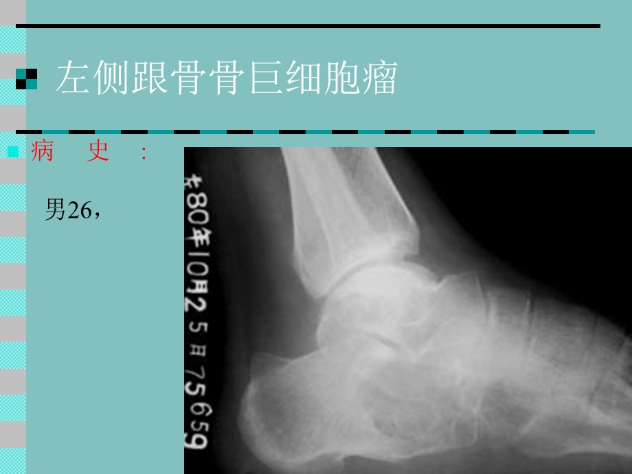 医学影像 骨肿瘤X线病例图谱（详细）课件.ppt_第3页