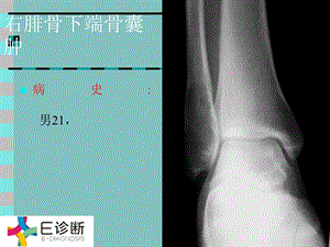 医学影像 骨肿瘤X线病例图谱（详细）课件.ppt