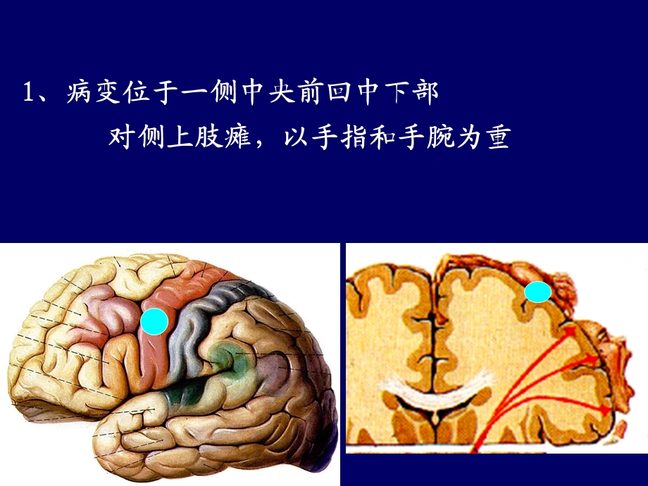 医学资料神经内科定位诊断课件.ppt_第3页