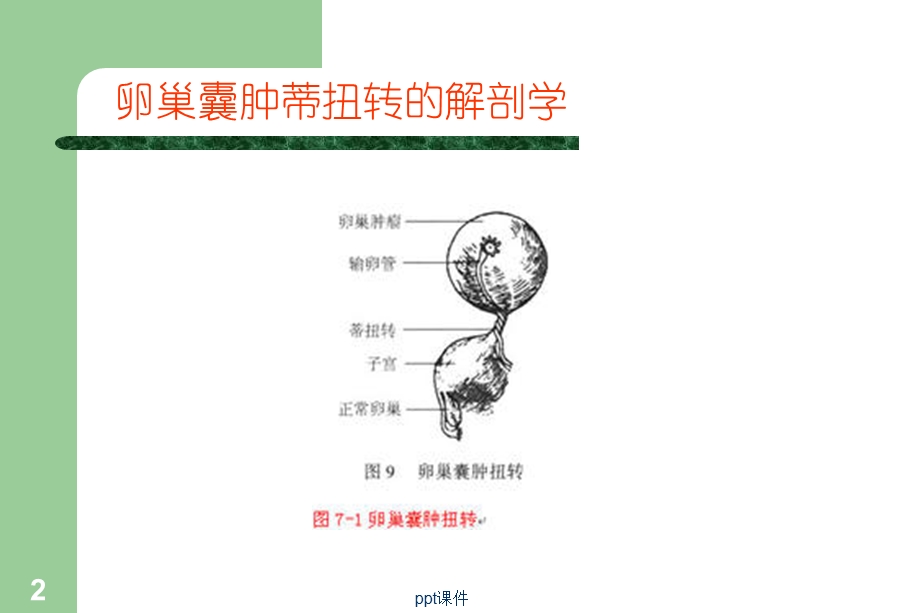 卵巢囊肿蒂扭转的诊断与治疗课件.ppt_第2页