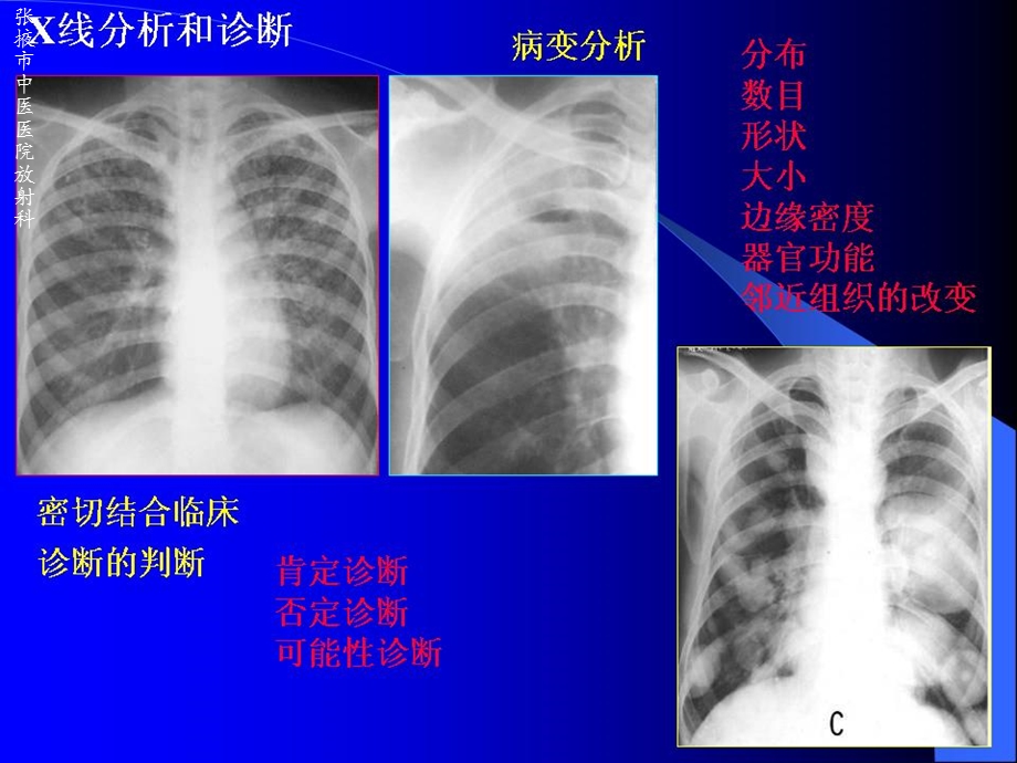 如何阅读胸片课件.ppt_第3页