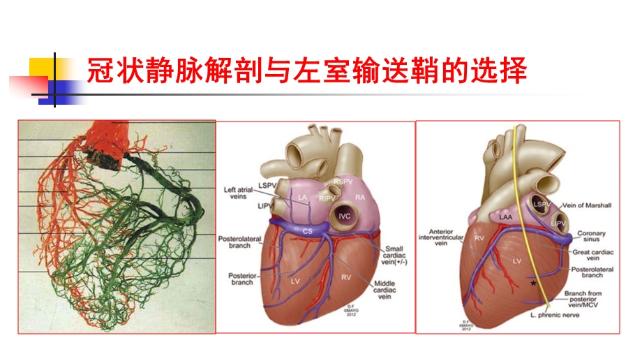 冠状静脉解剖与左室导线选择剖析课件.ppt_第3页