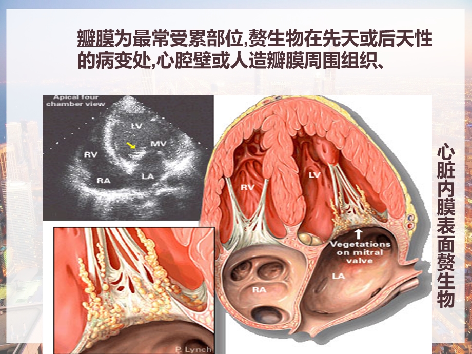 内科护理学感染性心内膜炎课件.pptx_第2页