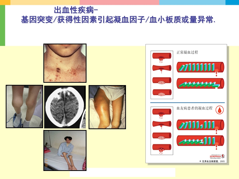 出血性疾病诊断思路课件.ppt_第3页