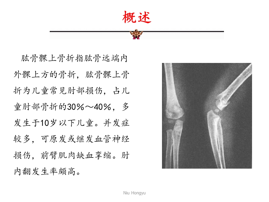 小儿肱骨髁上骨折的护理教材课件.ppt_第3页