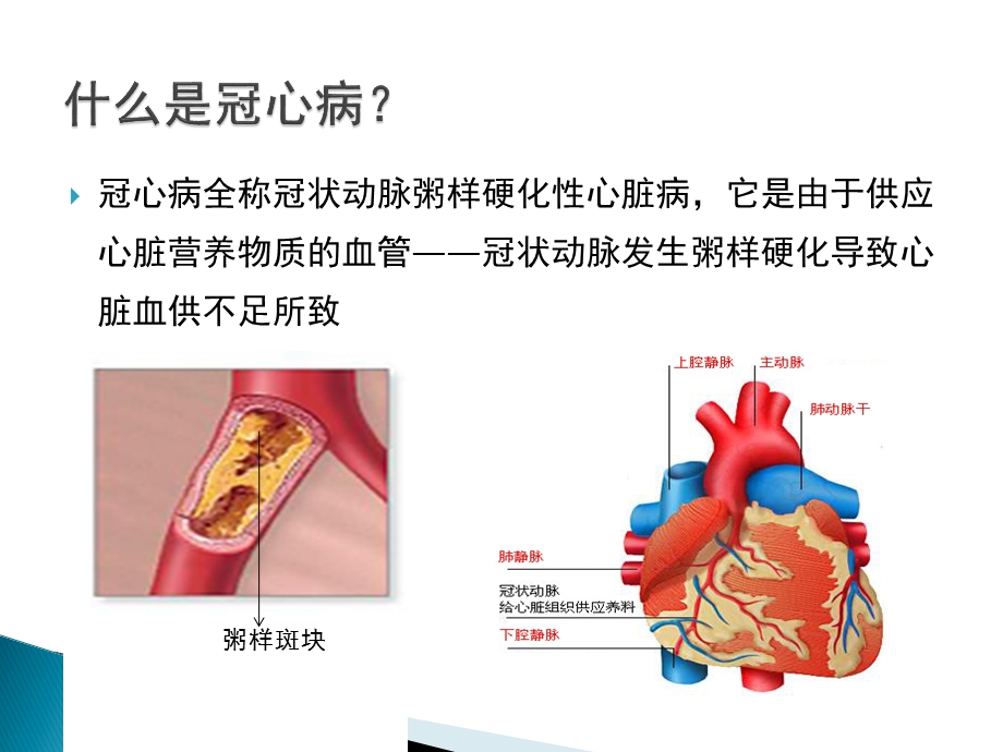 冠心病的介入治疗课件.pptx_第3页