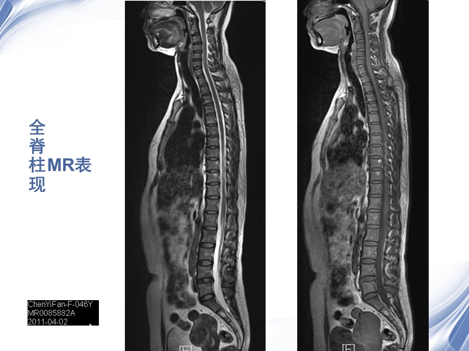 医学影像 脊柱外伤影像学表现课件.ppt_第3页