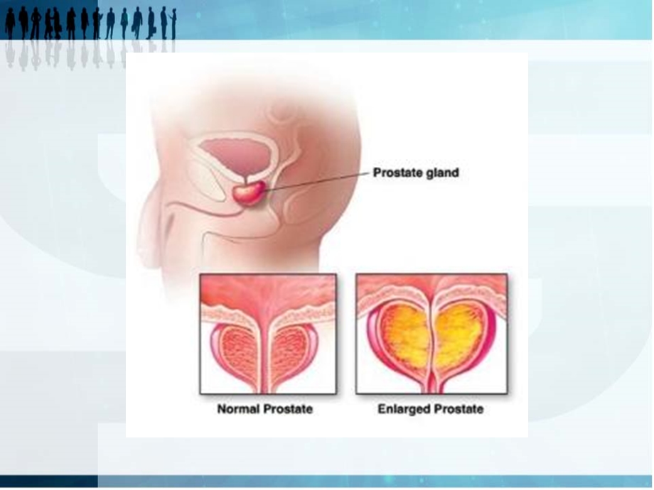 前列腺增生护理课件.pptx_第3页