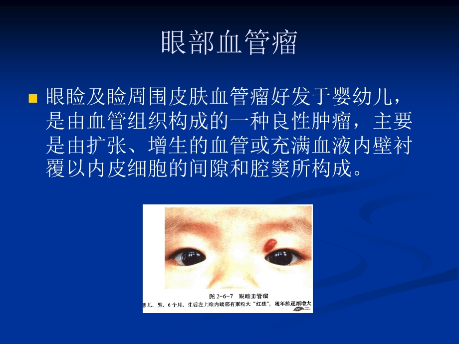 儿童常见眼部肿瘤课件.ppt_第2页