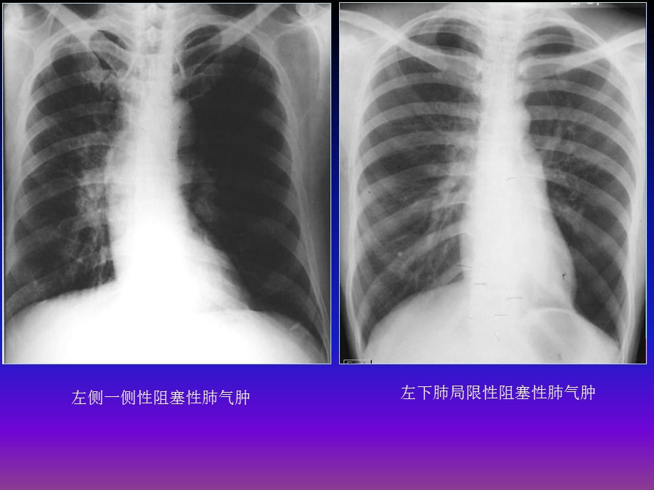 呼吸系统X线基本病变课件.ppt_第3页