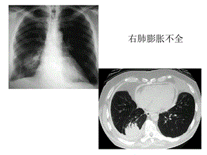 医学影像精品课程之肺部炎症课件.ppt