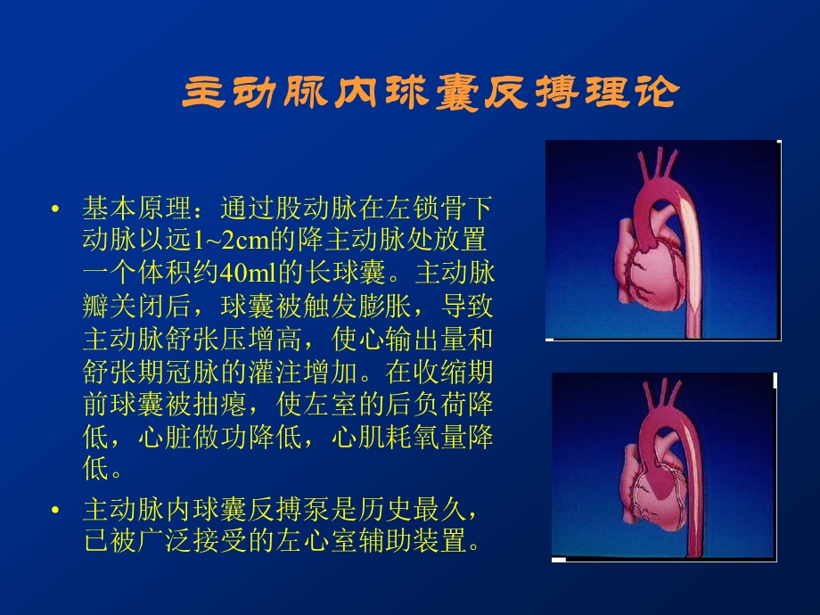 主动脉内球囊反搏教学课件.ppt_第3页