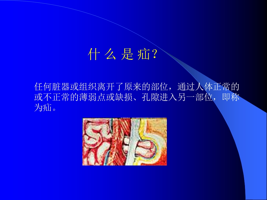 小儿腹股沟斜疝课件.ppt_第2页