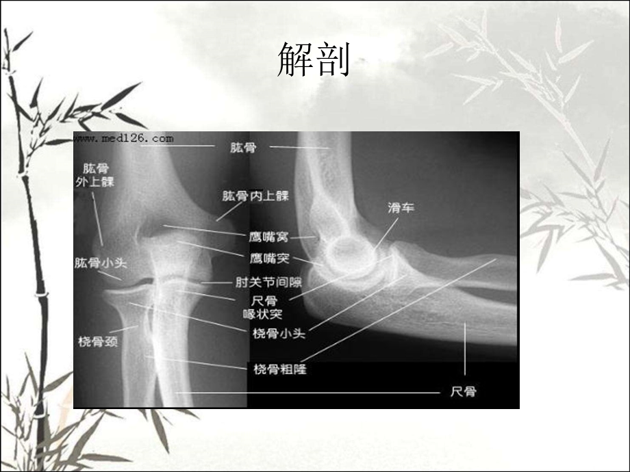 小儿肱骨髁上骨折课件.ppt_第2页