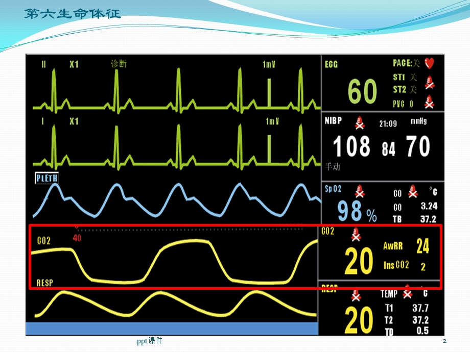 呼气末二氧化碳分压的临床应用课件.ppt_第2页