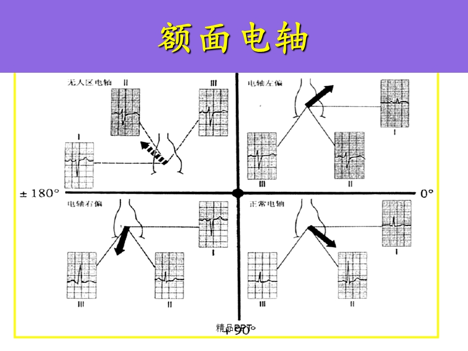 室性早搏、室性心动过速的体表心电图定位诊断课件.ppt_第3页