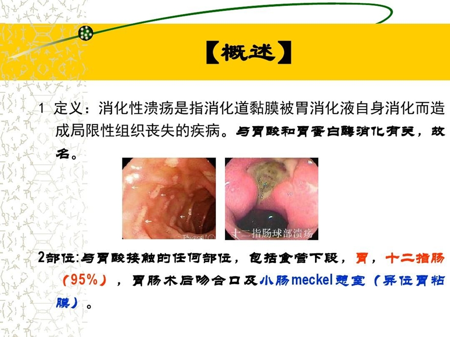 小儿消化性溃疡课件.ppt_第3页